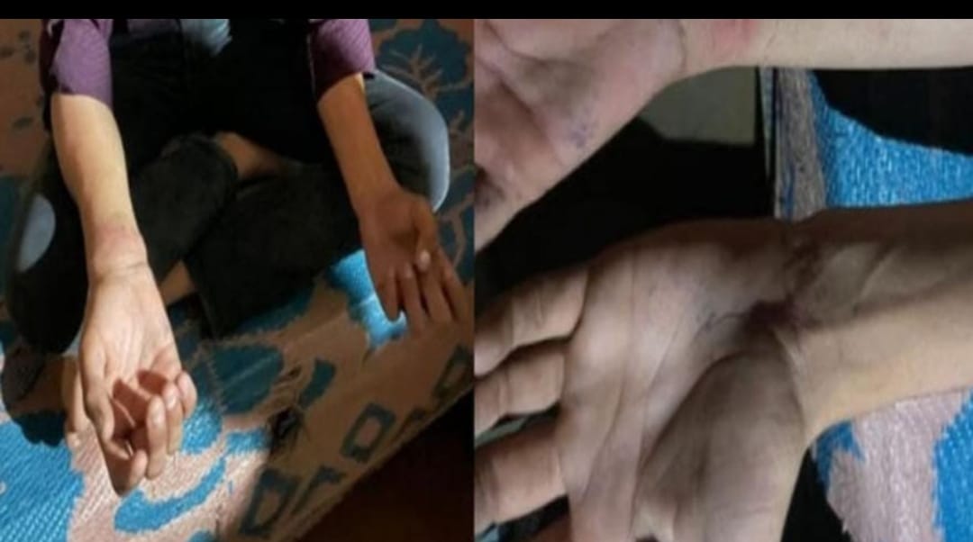 चौकी में ‘इंसाफ’ की जगह अत्याचार! 10 वीं के छात्र का हाथ टूटा, दो दरोगा निलंबित